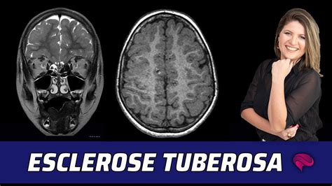 esclerose tuberosa fotos-4